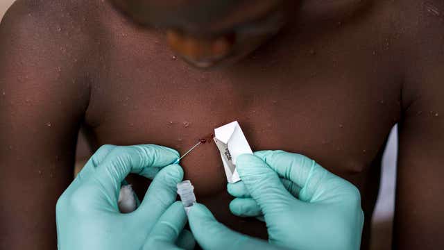 What is Monkeypox? What are Monkeypox symptoms? Answers about a rare disease