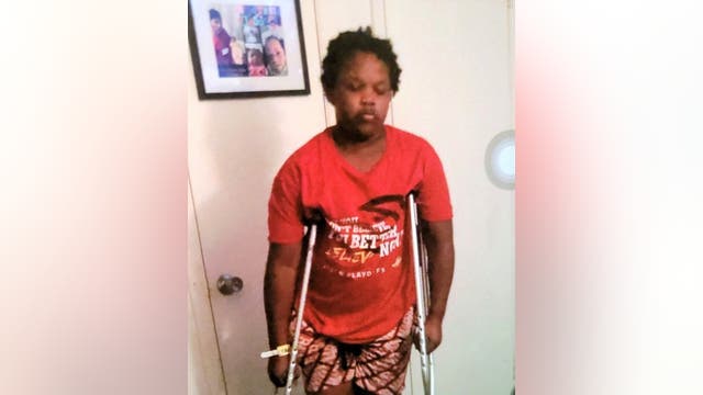 Police searching for 11-year-old with cast on right foot