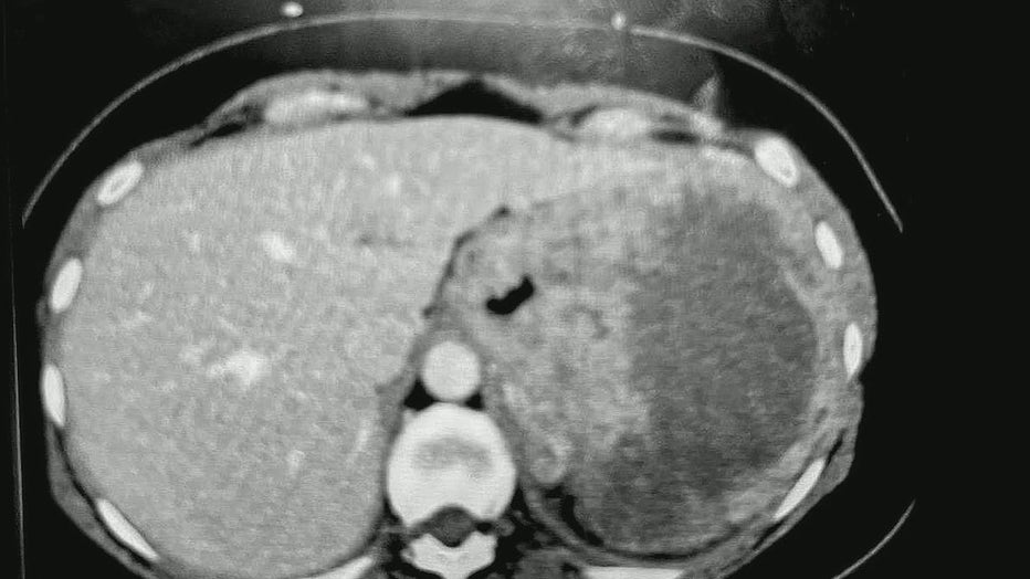 An MRI showing a mass under a bleeding ulcer.