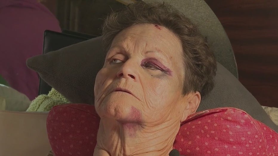 Mary Cornett, 69, is recovering after being struck by a car in the Brandywine subdivision.