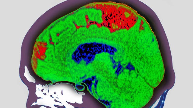 What is a cerebrovascular accident?
