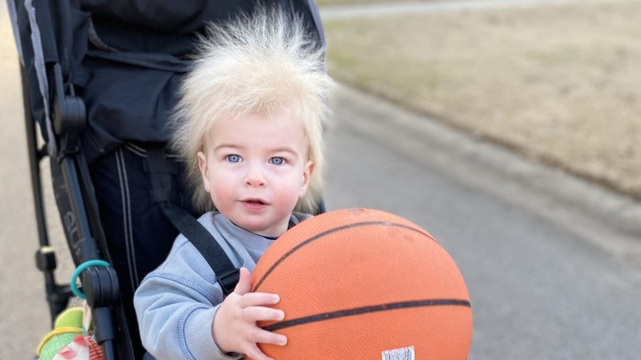 Rare Genetic Condition Gives Toledo Boy Uncombable Hair  The Daily  Chronicle