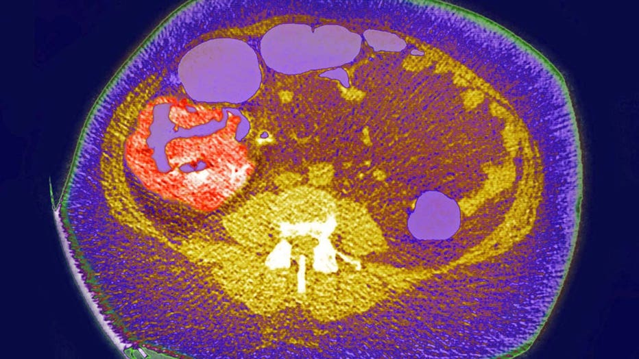 84cdf3d7-Colon cancer screening