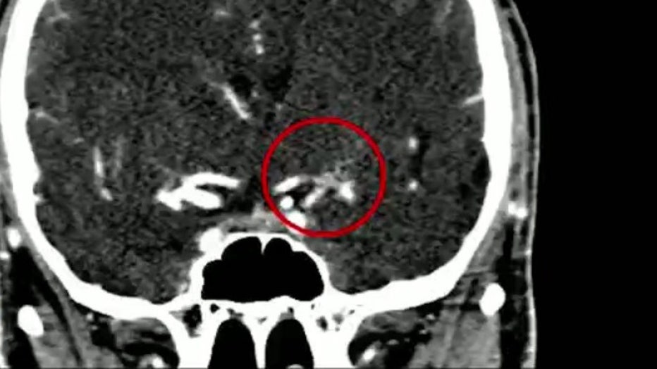 Images of a 25-year-old Georgia man's brain from Piedmont Atlanta's Comprehensive Stroke Center. 
