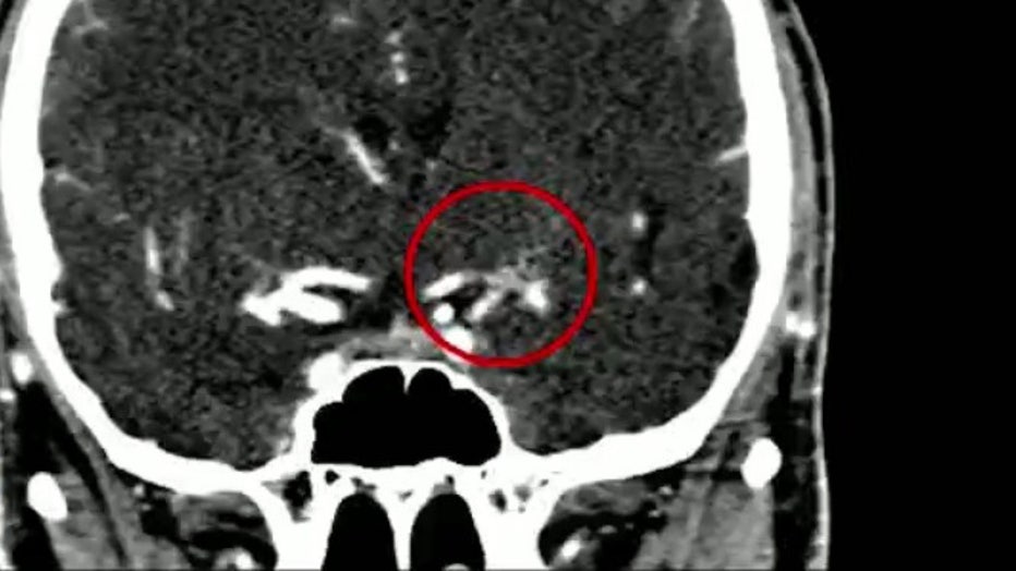 Images of a 25-year-old Georgia man's brain from Piedmont Atlanta's Comprehensive Stroke Center.