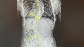 Teen athlete sidelined by spine surgery gets help for scoliosis