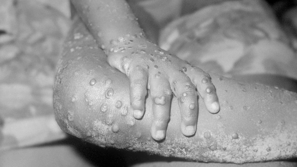 Monkeypox reported in Sacramento; 1st known case in California
