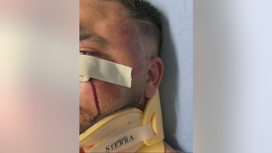 This picture of a 22-year-old man shows injuries he said he received after being beaten up at a Gwinnett County park on May 4, 2022.