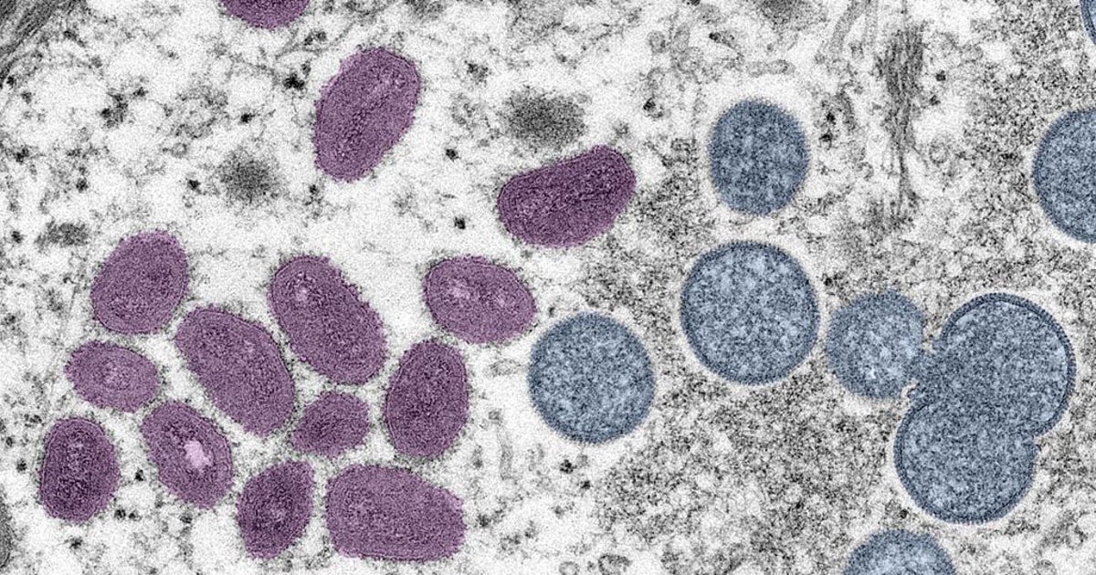 WHO considers declaring monkeypox a global health emergency