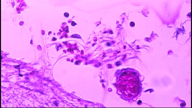 Health officials investigate major meningococcal disease in Florida