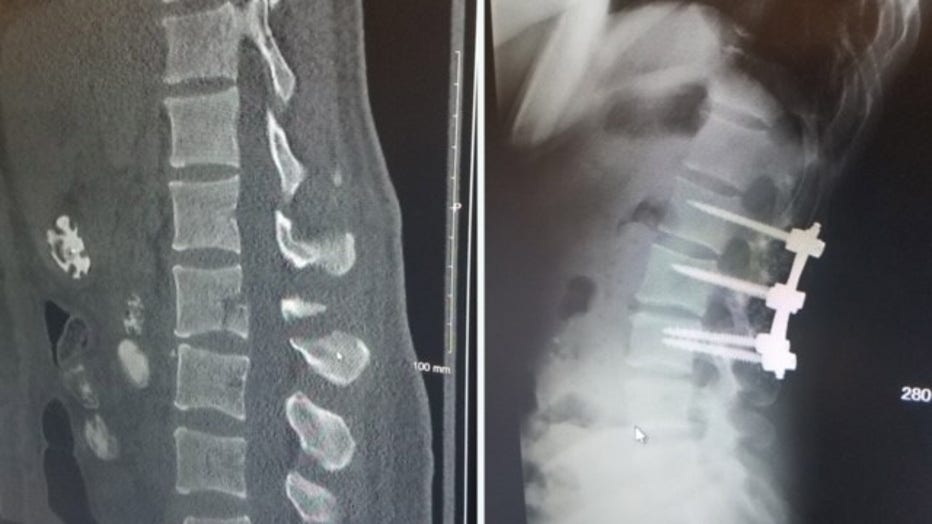 SIde-by-side x-rays show fractures in the spine and titanium rods holding 3 vertebrae together.