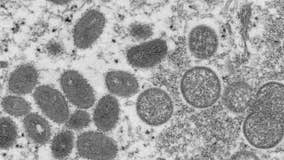 Georgia reports first case of monkeypox in adult woman