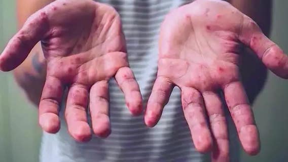 Georgia health officials address confusion over monkeypox testing