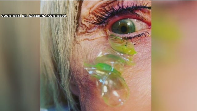 VIDEO: Newport Beach doctor removes 23 contact lenses from woman's eye