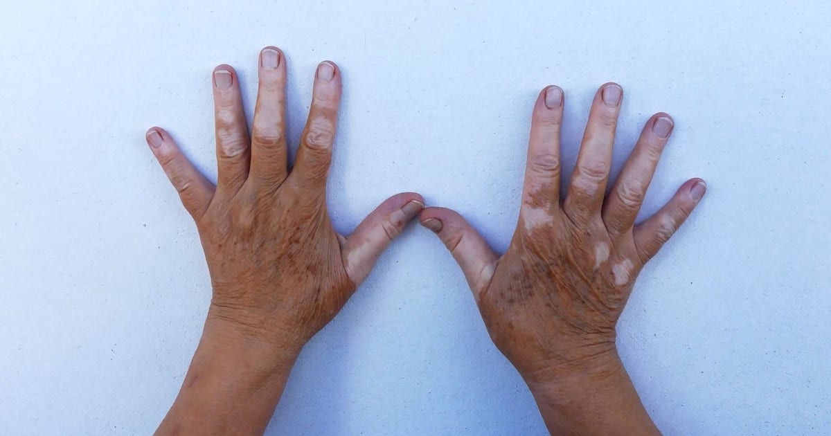 New vitiligo treatment may restore lost pigment for some patients | FOX ...