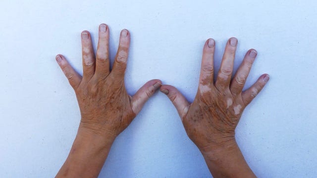 New vitiligo treatment may restore lost pigment for some patients