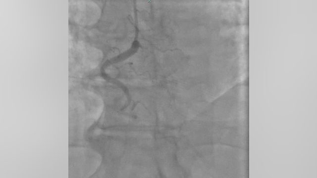 Program helps Georgia heart attack survivor get more active