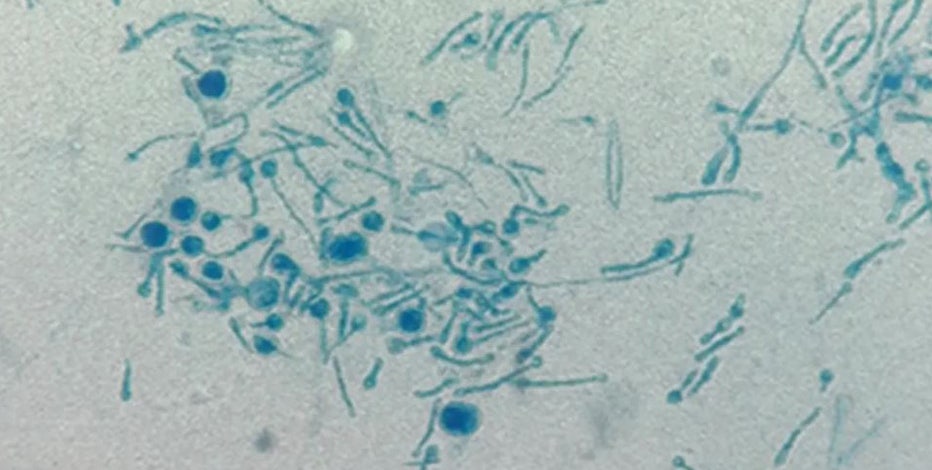 Dangerous plant fungus infects man in first-known global case