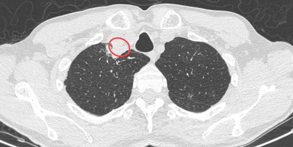 Dangerous plant fungus infects man in first-known global case