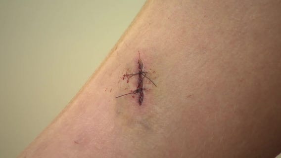 Banks County boy survives rabid bobcat attack