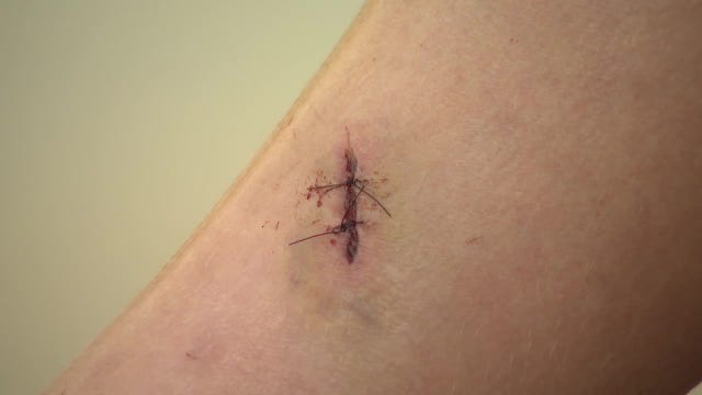 Banks County boy survives rabid bobcat attack