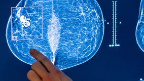 Artificial intelligence helping detect early signs of breast cancer in some US hospitals