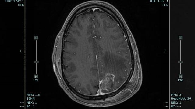 Facing tough diagnosis, Atlanta couple finds refuge in beekeeping