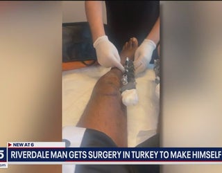 Turkey leg lengthening surgery: Georgia man has £86,000 surgery to make  himself 9 inches taller