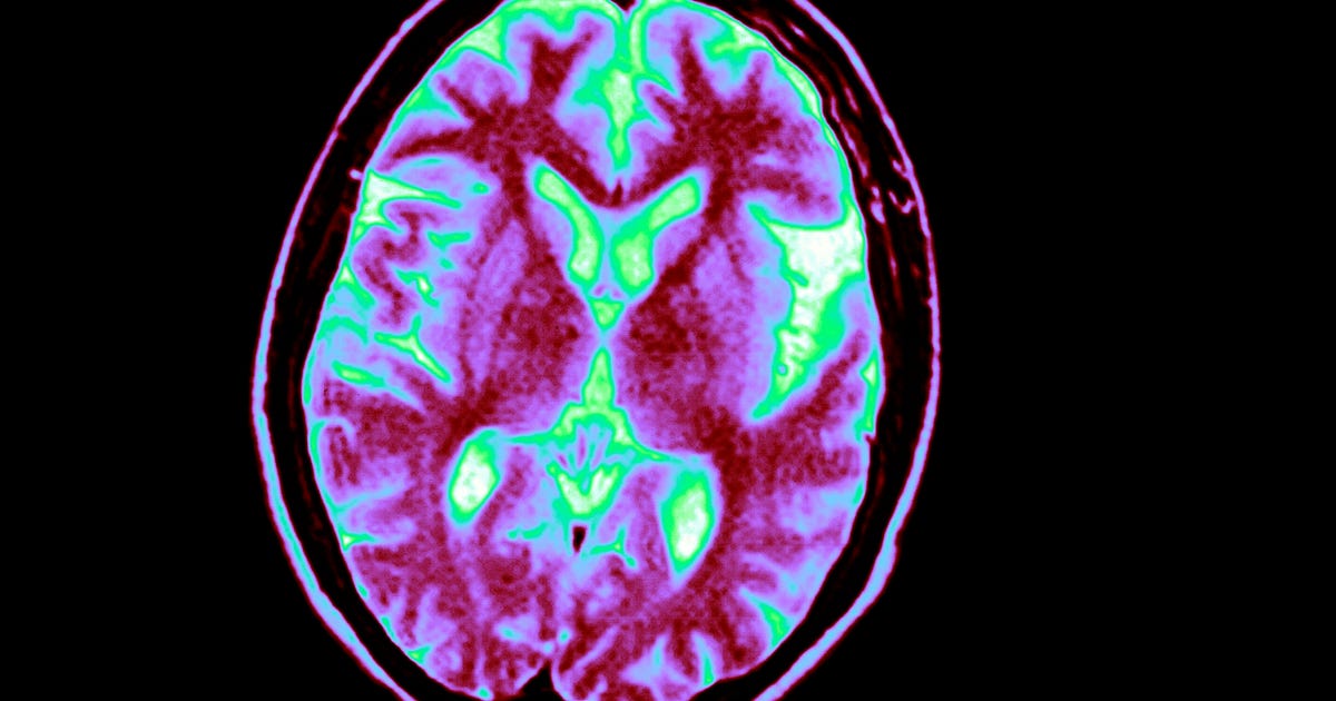 First Alzheimer's disease risk assessment blood test for consumers hits ...
