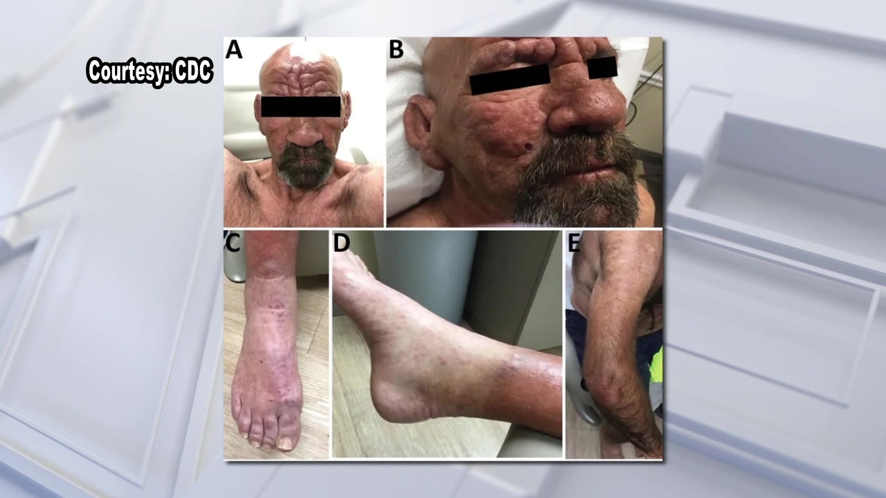 Leprosy considered endemic to Central Florida health officials say Leprosy considered endemic to Central Florida health officials say