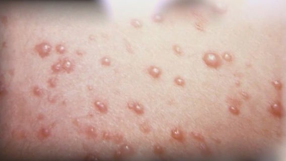 If you've ever had chickenpox, you can get shingles. Here is who should get vaccinated against it.