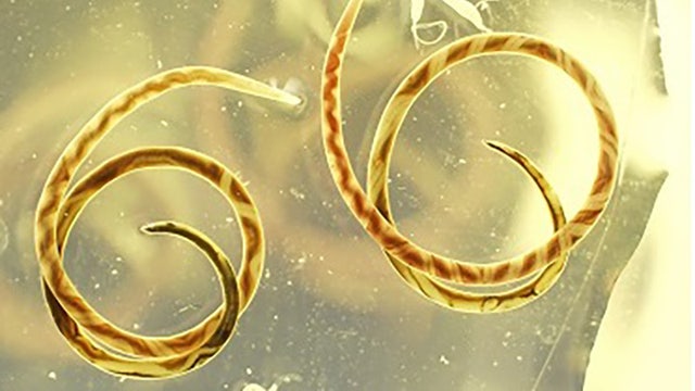 Parasitic worm that can enter brain found in Atlanta, researchers say