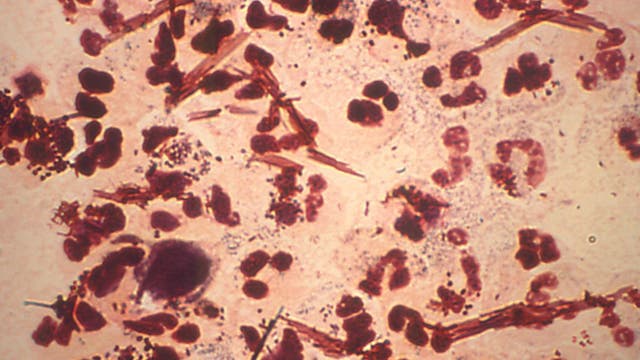 Gonorrhea, Chlamydia, Syphilis cases on the rise in Georgia