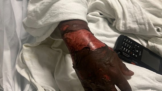 Wife of Atlanta security guard burned trying to save protester asks for prayers