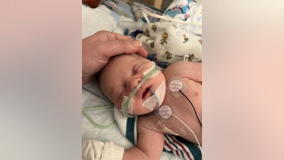 Buford newborn first in Georgia to be placed on kidney dialysis machine designed for babies