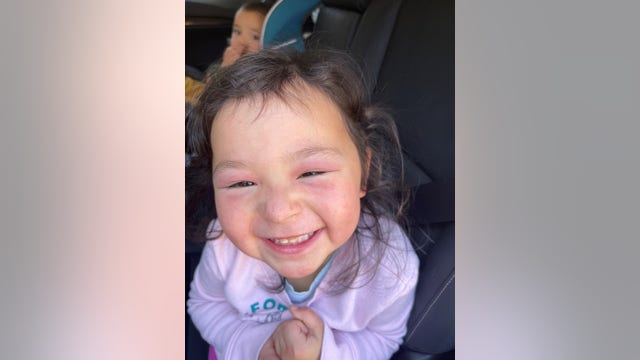 Georgia 4-year-old's eyelid rash leads to medical mystery