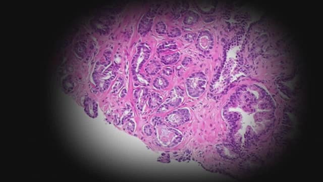 Dexter King's 3-year battle against prostate cancer a reminder to get screened early