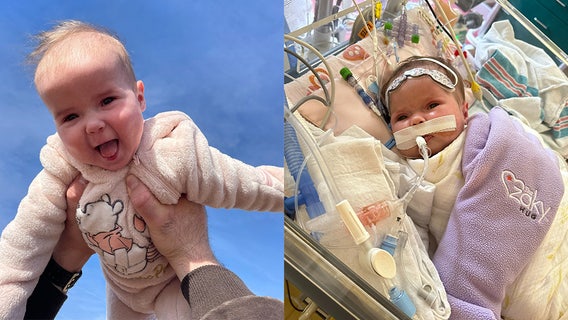 Infant undergoes successful open heart surgery at Children's Healthcare of Atlanta