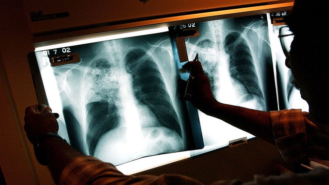 DeKalb County launches cutting-edge TB clinic to combat rising cases