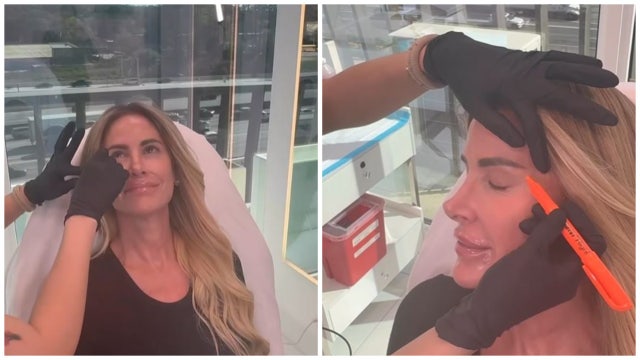'Real Housewives of Atlanta' star Kim Zolciak criticized for getting facial injections
