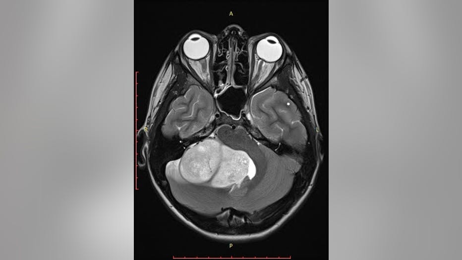 An MRI image of the brain shows a large white mass, a tumor, in the back of the brain.