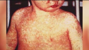 Georgia confirms third case of measles linked to unvaccinated person who traveled internationally