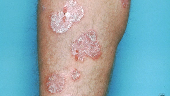 Plaque psoriasis plagues Marietta man for over 30 years until new treatment