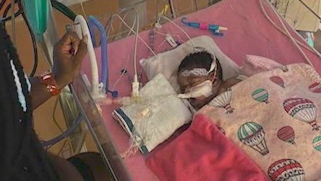 Mom: Rare surgery using 3D technology saved her child's quality of life