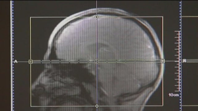 Emory Integrated Memory Care offering new payment model for patients