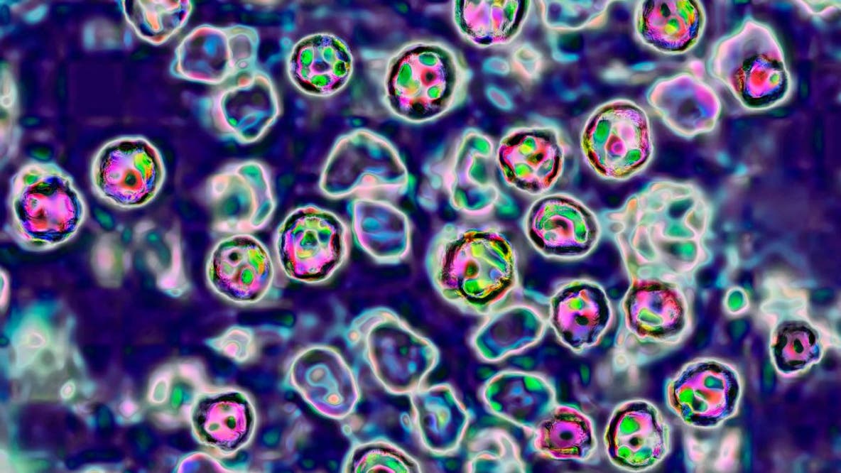 5 new measles cases confirmed in Jasper County family