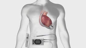 Emory doctors first in U.S. to successfully perform new 'experimental' heart pump surgery