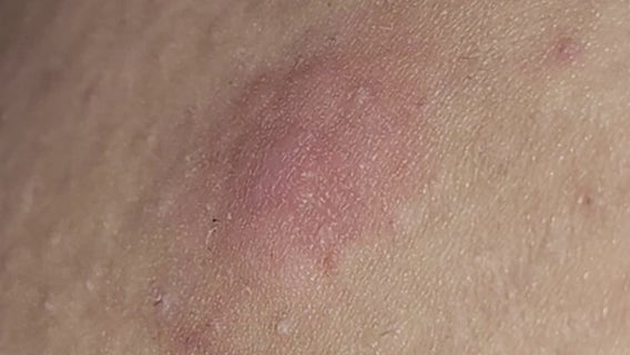 Hidradenitis Suppurativa: Often misdiagnosed, especially among Black women