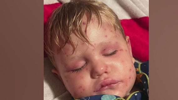 2-year-old Georgia toddler stung more than 150 times by yellowjackets
