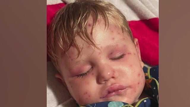 2-year-old Georgia toddler stung more than 150 times by yellowjackets